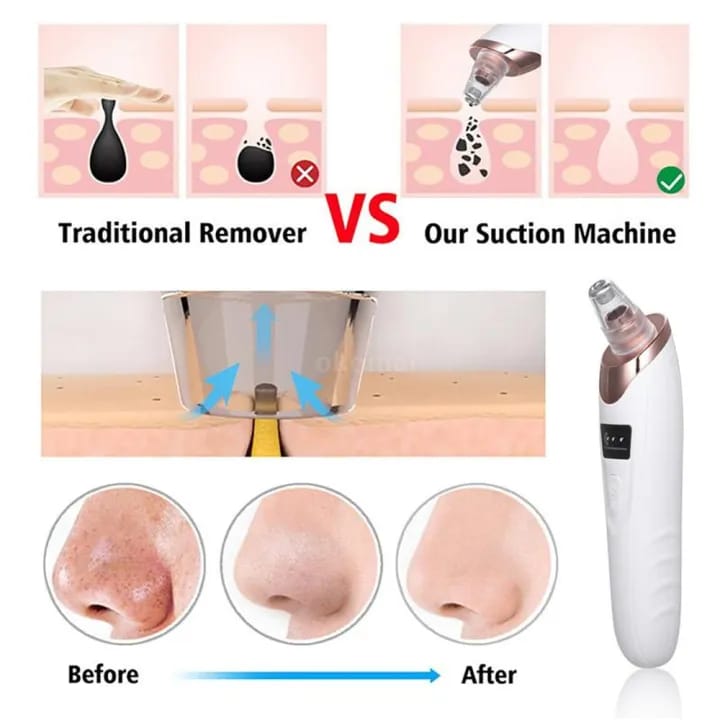 Electric Blackhead Remover Vacuum – Deep Pore Cleaner & Facial Acne Extractor